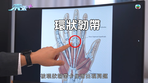 港男北上求醫「彈弓指」慘變中指永久殘廢！恐怖醫療陷阱！港醫證肌腱已遭過度切除
