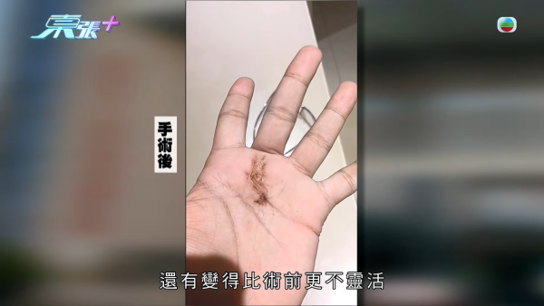 港男北上求醫「彈弓指」慘變中指永久殘廢！恐怖醫療陷阱！港醫證肌腱已遭過度切除