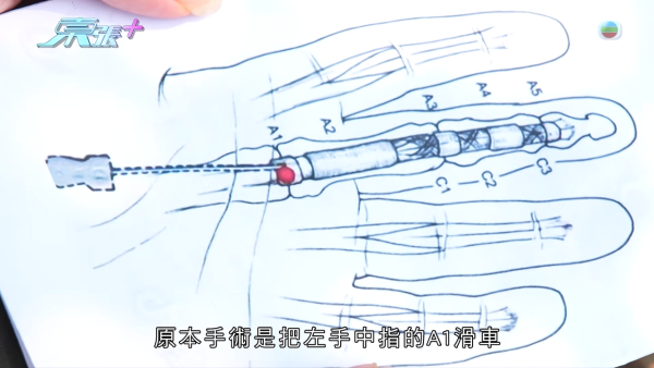 港男北上求醫「彈弓指」慘變中指永久殘廢！恐怖醫療陷阱！港醫證肌腱已遭過度切除