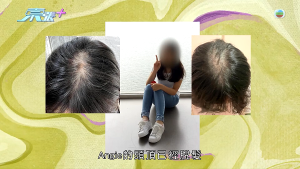 港女17岁起脱发受尽折磨！4000元再生纹发惊变烂头皮触目惊心 揭美容院颜料疑似淘宝同款