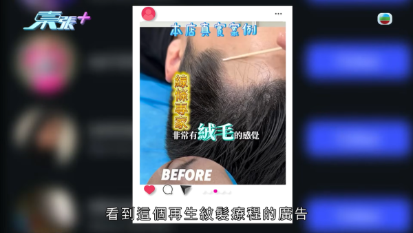 港女17岁起脱发受尽折磨！4000元再生纹发惊变烂头皮触目惊心 揭美容院颜料疑似淘宝同款