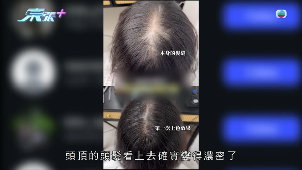 港女17岁起脱发受尽折磨！4000元再生纹发惊变烂头皮触目惊心 揭美容院颜料疑似淘宝同款