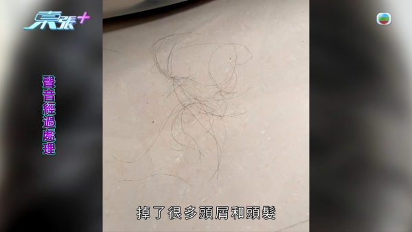 港女17岁起脱发受尽折磨！4000元再生纹发惊变烂头皮触目惊心 揭美容院颜料疑似淘宝同款