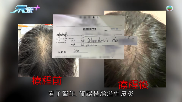 港女17岁起脱发受尽折磨！4000元再生纹发惊变烂头皮触目惊心 揭美容院颜料疑似淘宝同款