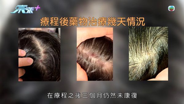 港女17岁起脱发受尽折磨！4000元再生纹发惊变烂头皮触目惊心 揭美容院颜料疑似淘宝同款