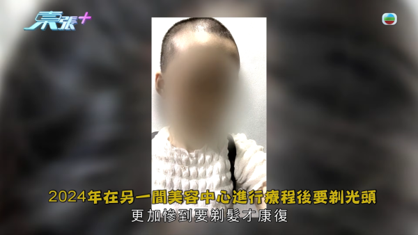 港女17岁起脱发受尽折磨！4000元再生纹发惊变烂头皮触目惊心 揭美容院颜料疑似淘宝同款