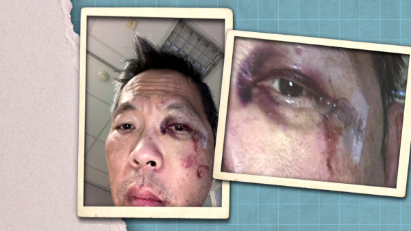 港大医学院院长刘泽星曾经面骨多处断裂！“痛脚”困扰7年敲断4条脚趾骨极痛