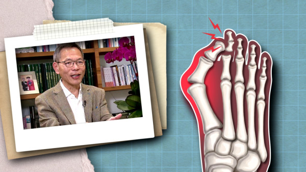 港大医学院院长刘泽星曾经面骨多处断裂！“痛脚”困扰7年敲断4条脚趾骨极痛