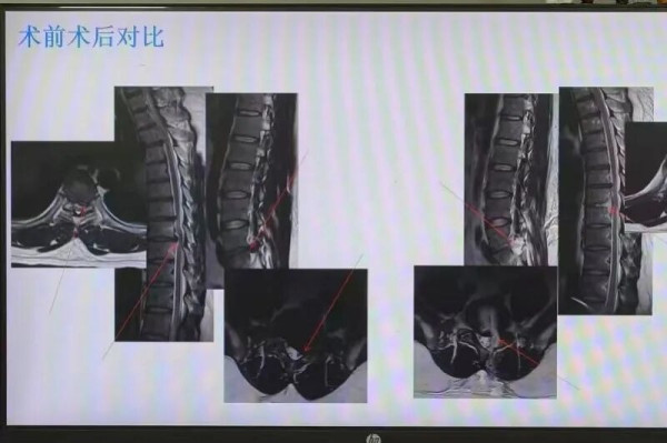 30歲醫生腰痛墊枕頭睡覺紓緩導致癱瘓！大小便失禁須緊急手術搶救