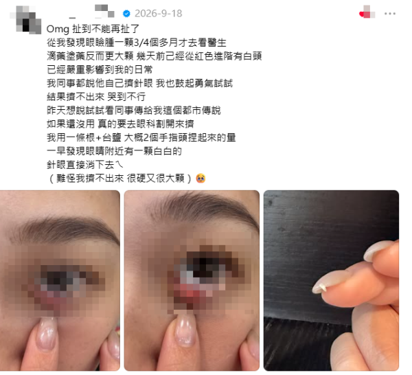 网传撒隆巴斯加盐放肚脐治麦粒肿！网友实测：隔日即消肿！中西医警告恐发炎或致腹膜炎