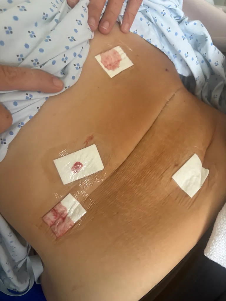 38歲女打瘦瘦針9個月激減51kg！為作伴娘暴瘦慘患結石終切除膽囊