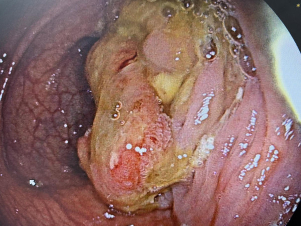 50歲男無不適0症狀竟已患大腸癌！腫瘤爆生已轉移至肝臟／醫點名6高危養癌壞習慣