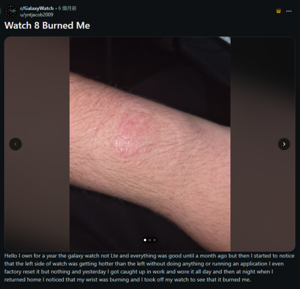 戴 Galaxy Watch 睡覺遭燙傷？多名苦主手腕驚現紅斑水泡　外媒拆解原因【附 5 招安全佩戴貼士】