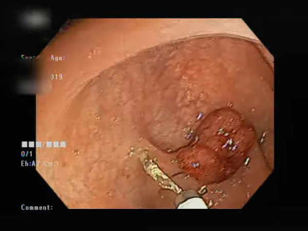 23歲女運動員竟確診大腸癌！作息正常無血便無家族史／醫嘆做到1事幸保性命