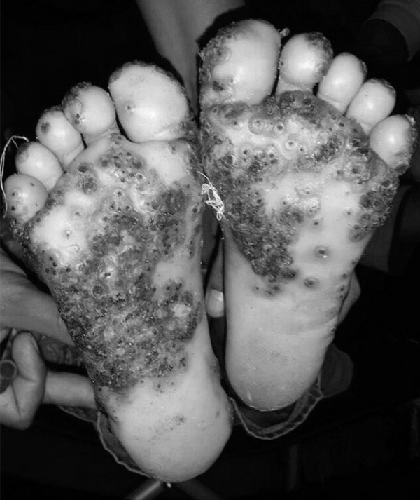 10 歲女童赤腳走被蚤咬！ 腳板底爛肉滿佈膿瘡【恐怖慎入】