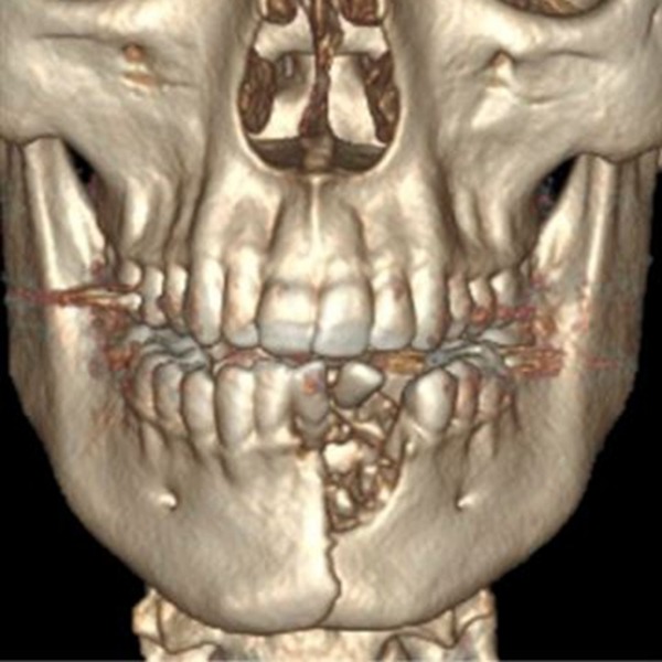 電子煙口中爆炸 少年牙齒被炸飛下顎骨折