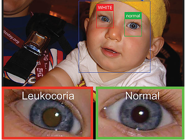 美國大學開發手機 App  藉相片及早發現兒童眼疾