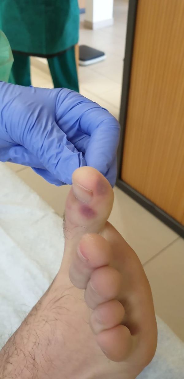 【新冠肺炎】西班牙專家新發現  腳上長紫色痘或是患病先兆