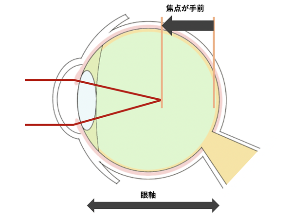 眼鏡可以醫近視？日本 Kubota Vision 智能眼鏡聲稱可治近視