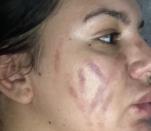 少女使用真空吸黑頭機護膚  3 分鐘後臉上現瘀痕險毀容