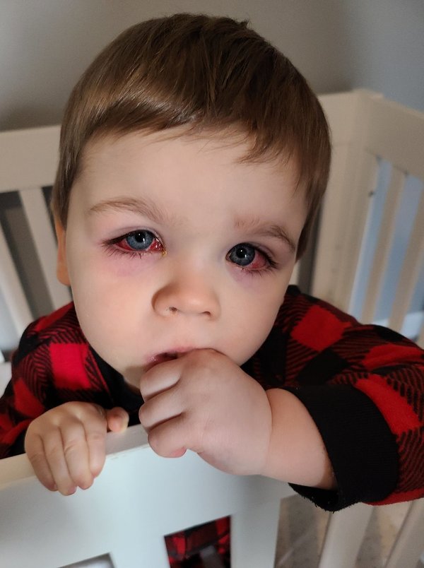2 歲童遭噴水浴室玩具積水射眼  雙眼細菌感染險失視力