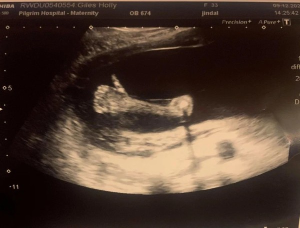 懷孕 5 個月照超聲波  胎兒擺「Like」手勢成熱話
