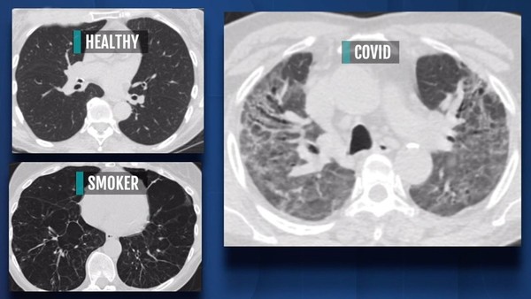 【新冠肺炎】患者肺部全花比吸煙更嚴重？ 無症狀患者肺部也會受損