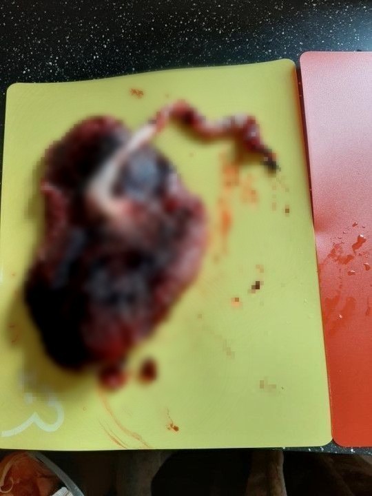 27 歲英國媽媽食胎盤補身  研究質疑「胎盤補身」有效性