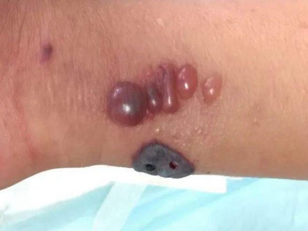 中國山西疑出現炭疽病個案  9 人皮膚變黑潰爛