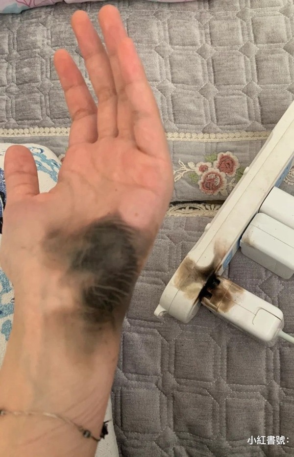 插 Apple Mac 電腦充電插頭突然爆炸 事主手部熏黑燒斷手鏈