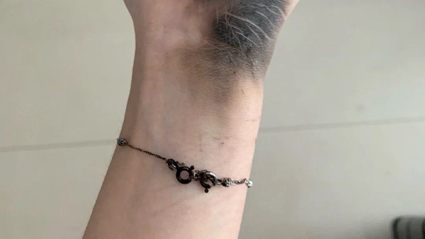 插 Apple Mac 電腦充電插頭突然爆炸 事主手部熏黑燒斷手鏈