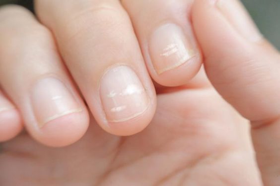 指甲容易折斷或出現白點，可能是身體缺乏鐵、鈣、鋅及生物素。另外，身體有貧血傾向，指甲會因血液不足而變得脆弱。