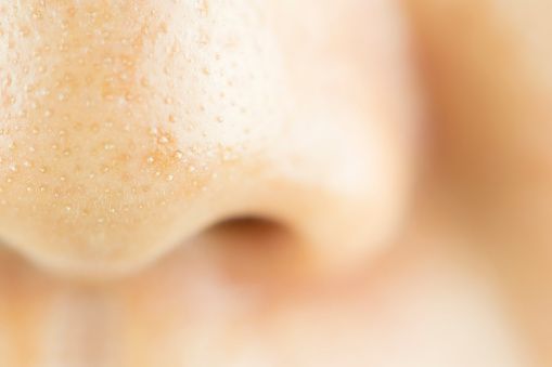 1.去黑頭：把軟膏敷在鼻上約5分鐘，然後把軟膏抹掉再使用黑頭鼻貼清除污垢。能有效軟化角質，令黑頭更容易浮出。