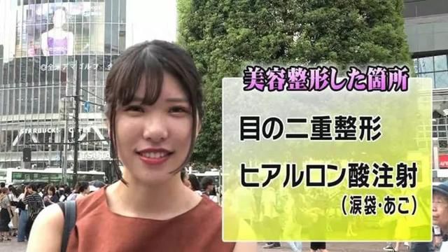 第1位受訪者：割雙眼皮，以及玻尿酸注射臥蠶蠶及下巴。（圖片來源：めざましテレビ）