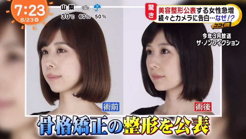 她列舉了女性公開整容的例子「有村藍里早前公開整容，受到了大眾支持讚賞。」（圖片來源：めざましテレビ）