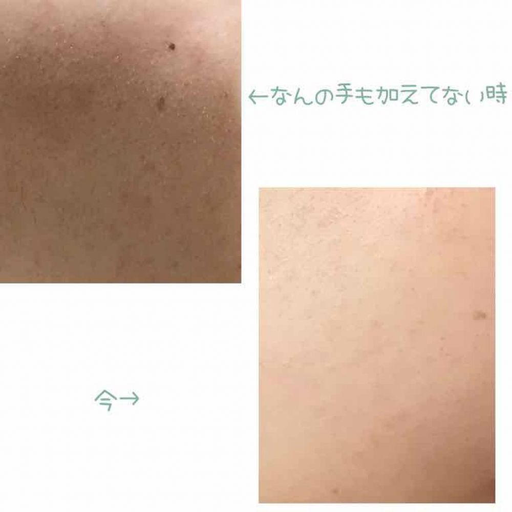 按上述方法護膚後，這位日本女網友的皮膚狀況由上圖變為下圖。