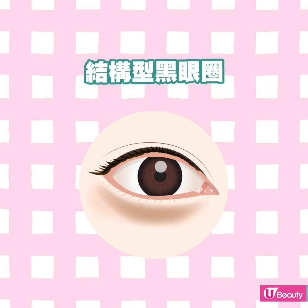 結構型黑眼圈：眼袋位置向前隆起形成袋型，嚴重眼袋底部更有橫摺皺紋及色素沉澱問題。