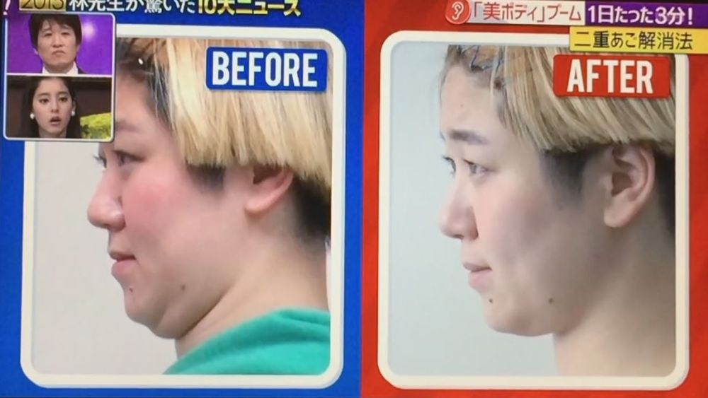 節目邀請這位女生試驗2星期，可以看見雙下巴真的有所改善。步驟如下︰