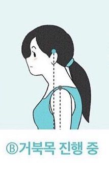 B:輕微寒背。放輕鬆站立時,頭部較難完全貼牆,腰間和牆壁之間空間較大,大約可放前臂。同時,耳朵頂端點與肩膀的距離約有2.5cm的差距,意味着「烏龜頸」的狀況正出現你身上。 B:輕微寒背。放輕鬆站立時,頭部較難完全貼牆,腰間和牆壁之間空間較大,大約可放前臂。同時,耳朵頂端點與肩膀的距離約有2.5cm的差距,意味着「烏龜頸」的狀況正出現你身上。