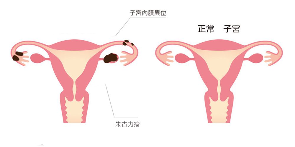 Q1. 朱古力瘤是什麼？  朱古力瘤，醫學上稱為子宮內膜異位。子宮內膜，顧名思義，是存在於子宮內的。子宮內膜會隨著月經周期的荷爾蒙變化而逐漸增厚並充血，為受孕做好準備。如果當月並未受孕，子宮內膜就會脫落，形成月經。但當部份本應存在於子宮內的內膜組織在子宮外的其他地方生長，這就是子宮內膜異位。與正常的子宮內膜一樣，這些異位的子宮內膜，同樣會隨著每次月經週期增厚並充血，而當血液流到體腔內，就會使患者發炎並感到疼痛。子宮內膜異位可以發生在輸卵管、子宮頸、陰道、甚至腸道或膀胱，但最常見於卵巢。由於卵巢內的子宮內膜異位常常會形成囊腫，囊腫內有棕色液體，因此被稱為「朱古力瘤」。子宮內膜異位的成因目前尚未明確，而主流觀點則認為，其發生與月經經血從輸卵管倒流至子宮有關。