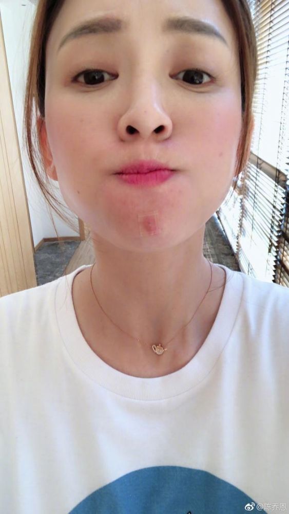 其實不然，撒隆巴斯貼布是緩解肌肉或關節的疼痛，如果把撒隆巴斯貼在臉部皮膚上，除了會造成阻塞，也有可能會造成刺激性皮膚炎。（圖片來源：Weibo@陳喬恩）