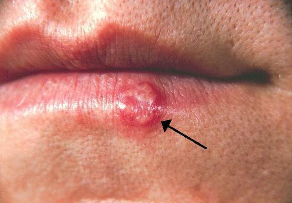【唇瘡】朱古力中的精氨酸致唇瘡　11種治療和引發唇瘡食物