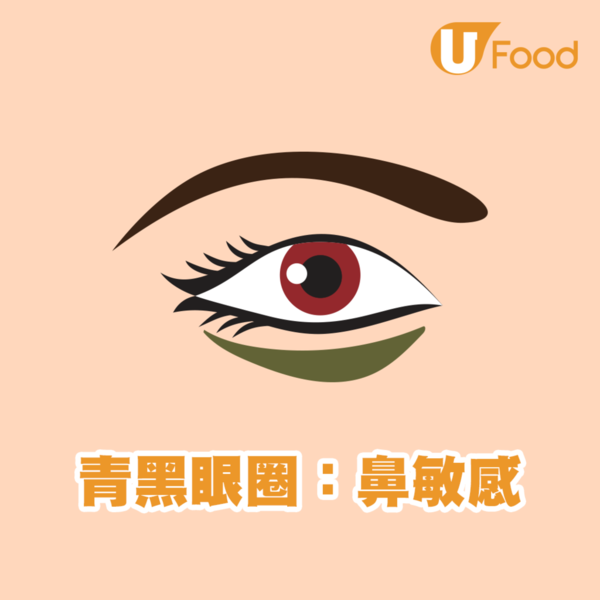 【黑眼圈】中醫教你分辨黑眼圈顏色代表什麼／3個熱敷方法去黑眼圈　鼻敏感是青色