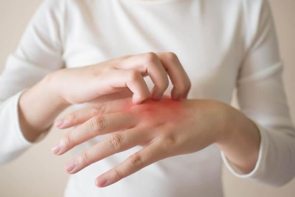 經常使用酒精搓手液消毒導致雙手脫皮痕癢  台灣醫生教3招減低患上手部濕疹