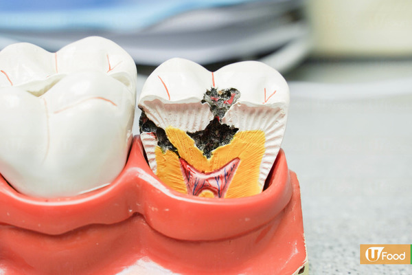 【美白牙齒】牙醫由內到外解構牙齒變黃原因 美白牙齒飲食方法及坊間迷思
