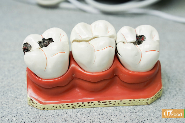 【美白牙齒】牙醫由內到外解構牙齒變黃原因 美白牙齒飲食方法及坊間迷思