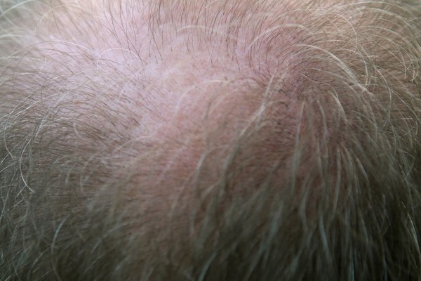 【omicron後遺症】中大研究：兩成新冠康復者出現脫髮後遺症 中醫解構脫髮原因／防脫髮方法／湯水食療推介