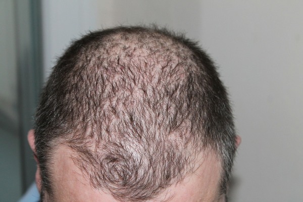 【omicron後遺症】中大研究：兩成新冠康復者出現脫髮後遺症 中醫解構脫髮原因／防脫髮方法／湯水食療推介