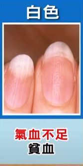 【指甲健康】 指甲直紋／凹陷／白點代表什麼？ 醫生解答15大指甲狀況與健康關係＋養甲茶療推介