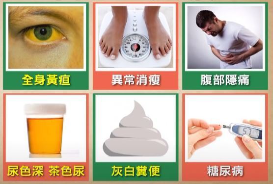 美國網紅法官Frank Caprio胰腺癌病逝享年88歲 什麼人容易有胰臟癌？